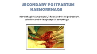 Hemorrhage occurs beyond 24 hours and within puerperium,
called delayed or late puerperal hemorrhage.
SECONDARY POSTPARTUM
HAEMORRHAGE
 