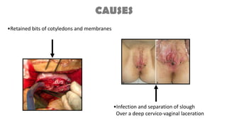 •Infection and separation of slough
Over a deep cervico-vaginal laceration
CAUSES
•Retained bits of cotyledons and membranes
 