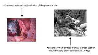 •Endometriosis and subinvolution of the placental site
•Secondary hemorrhage from caesarean section
Wound usually occur between 10-14 days
 