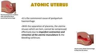 ATONIC UTERUS
Normal postpartum condition
with contracted uterus
preventing haemorrhage
Uterine atony allows haemorrhage
to flow into the uterus
•It is the commonest cause of postpartum
haemorrhage.
•With the separation of placenta, the uterine
sinuses which are torn, cannot be compressed
effectively due to imperfect contraction and
retraction of the uterine musculature & the
bleeding continues.
 