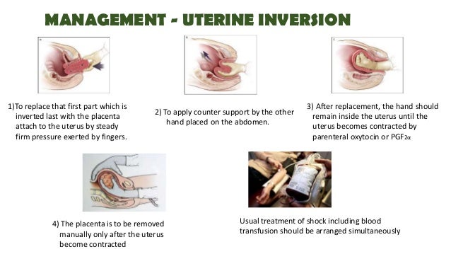 Diagram Of Inverted Uterus Image collections - How To 