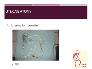 4. Uterine tamponade
UTERINE ATONY
 CBD
 