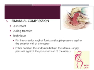 5. BIMANUAL COMPRESSION
 Last resort
 During transfer
 Technique
 Fist into anterior vaginal fornix and apply pressure against
the anterior wall of the uterus
 Other hand on the abdomen behind the uterus – apply
pressure against the posterior wall of the uterus
 