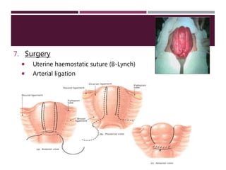 7. Surgery
 Uterine haemostatic suture (B-Lynch)
 Arterial ligation
 Hysterectomy
 