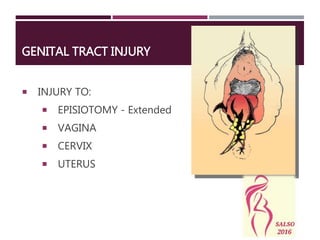 GENITAL TRACT INJURY
 INJURY TO:
 EPISIOTOMY - Extended
 VAGINA
 CERVIX
 UTERUS
 