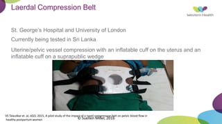Laerdal Compression Belt
St. George’s Hospital and University of London
Currently being tested in Sri Lanka
Uterine/pelvic vessel compression with an inflatable cuff on the uterus and an
inflatable cuff on a suprapublic wedge
VS Talaulikaret. al, IJGO, 2015, A pilot study of the impact of a novel compression belt on pelvic blood flow in
healthy postpartum women © Suellen Miller, 2016
 