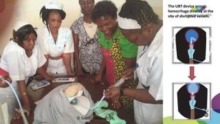 The UBT device arrests
hemorrhage directly at the
site of disrupted vessels.
© Suellen Miller, 2016
 