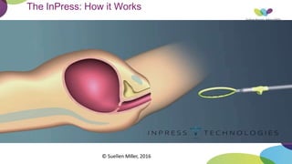 The InPress: How it Works
© Suellen Miller, 2016
 