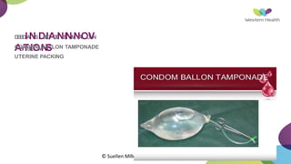 D
E
B
D
IA
NSD
B
L
I
O
A
O
D
N
E
S
I
N
T
I
M
N
A
T
O
I
O
V
N
AS
Y
TS
T
I
E
O
M
N
S
CONDOM BALLON TAMPONADE
UTERINE PACKING
© Suellen Miller, 2016
 