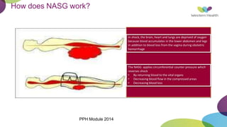 How does NASG work?
In shock, the brain, heart and lungs are deprived of oxygen
because blood accumulates in the lower abdomen and legs
in addition to blood loss from the vagina during obstetric
hemorrhage
The NASG applies circumferential counter pressure which
reverses shock
• By returning blood to the vital organs
• Decreasing blood flow in the compressed areas
• Decreasing blood loss
PPH Module 2014
 