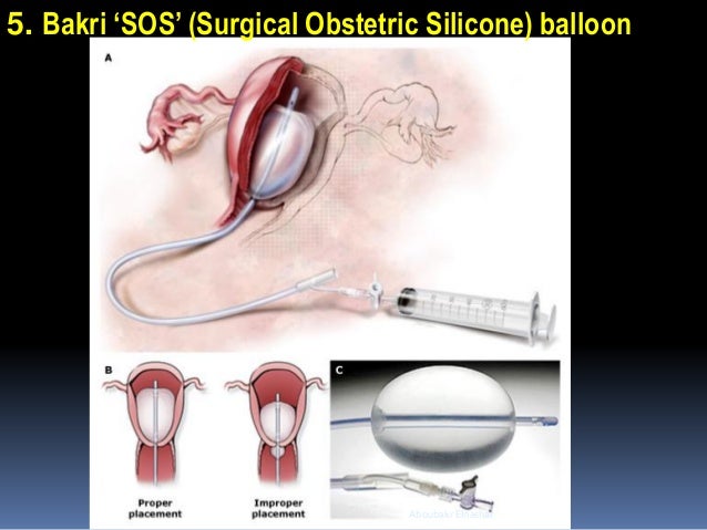 baloon tamponade in management of postpartum haemorrhage bakri balloon