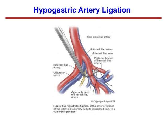 uterine artery embolization