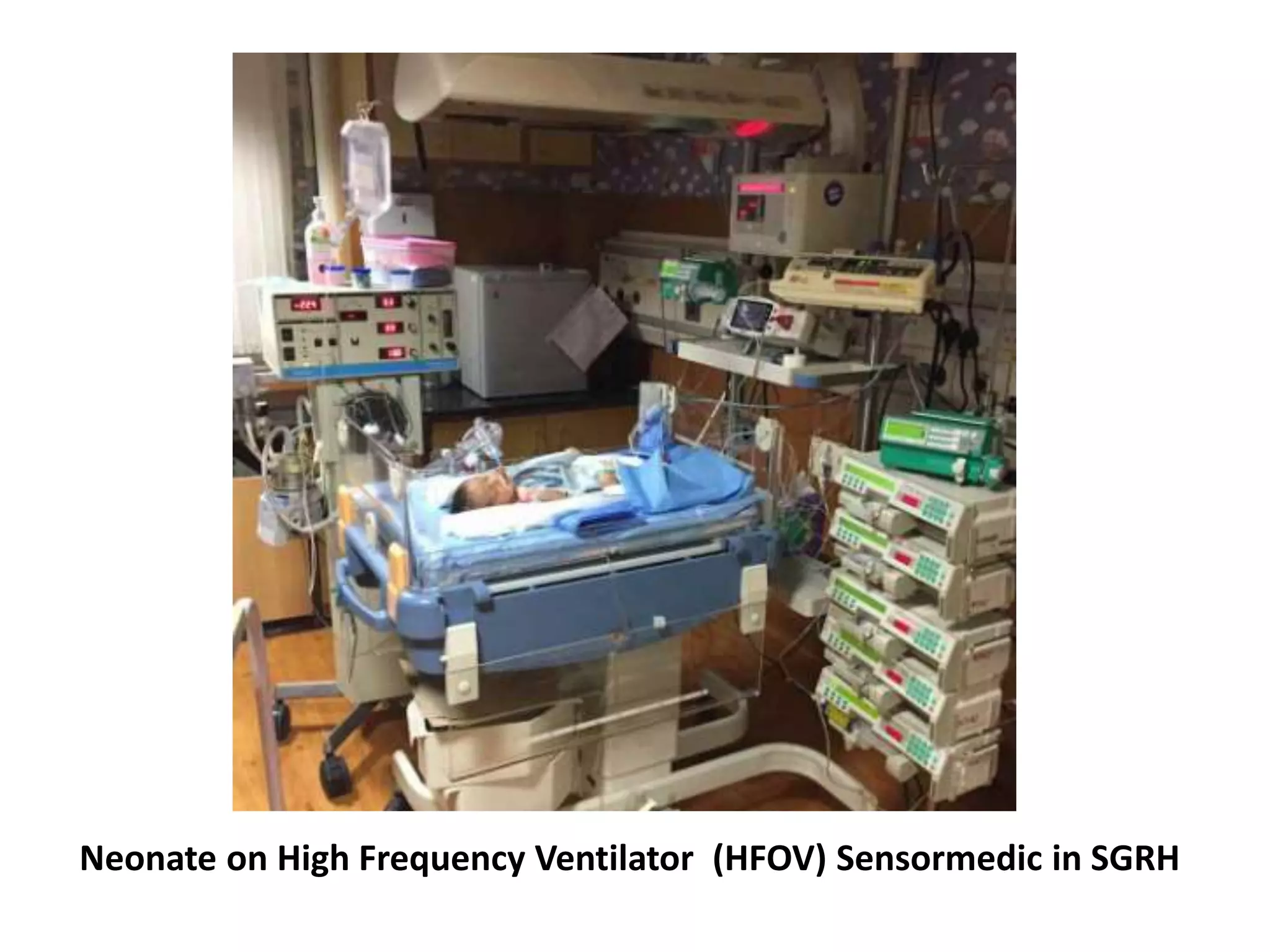 Neonate on High Frequency Ventilator (HFOV) Sensormedic in SGRH
 