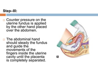 Step–III:
 Counter pressure on the
uterine fundus is applied
by the other hand placed
over the abdomen.
 The abdominal hand
should steady the fundus
and guide the
movements of the
fingers inside the uterine
cavity until the placenta
is completely separated.
 