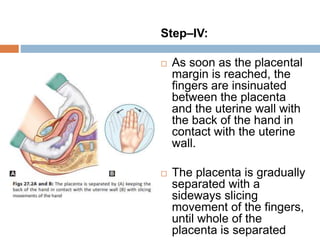 Step–IV:
 As soon as the placental
margin is reached, the
fingers are insinuated
between the placenta
and the uterine wall with
the back of the hand in
contact with the uterine
wall.
 The placenta is gradually
separated with a
sideways slicing
movement of the fingers,
until whole of the
placenta is separated
 