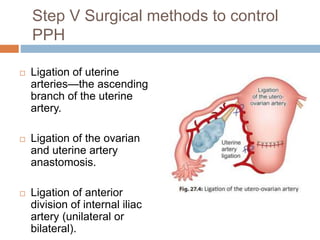 Step V Surgical methods to control
PPH
 Ligation of uterine
arteries—the ascending
branch of the uterine
artery.
 Ligation of the ovarian
and uterine artery
anastomosis.
 Ligation of anterior
division of internal iliac
artery (unilateral or
bilateral).
 