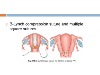  B-Lynch compression suture and multiple
square sutures
 
