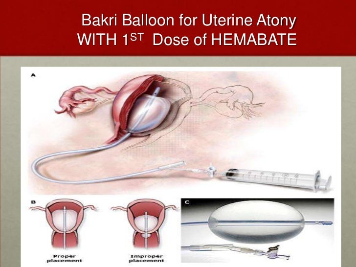 pph share drive bakri balloon