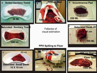 Fallacies of
visual estimation
Soiled Sanitary Towel
30 ML
Saturated Sanitary Towel
100 ml
Saturated Small Swab
10 X 10 cm
60 ml
Incontinence Pad
250 ML
Saturated Swab 45 c
X 45 cm
350 ML
100 cm Diamet
Floor Spill
1500 ML
PPH on Bed
1000 ML
PPH Spilling to Floor
2000 ML
 