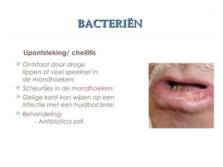 BACTERIËNBACTERIËN
Lipontsteking/ cheilitis
 Ontstaat door droge
lippen of veel speeksel in
de mondhoeken;
 Scheurtjes in de mondhoeken;
 Gelige korst kan wijzen op een
infectie met een huidbacterie;
 Behandeling:
- Antibiotica zalf.
 