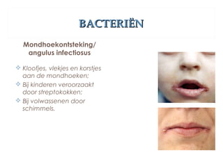 BACTERIËNBACTERIËN
Mondhoekontsteking/
angulus infectiosus
 Kloofjes, vlekjes en korstjes
aan de mondhoeken;
 Bij kinderen veroorzaakt
door streptokokken;
 Bij volwassenen door
schimmels.
 