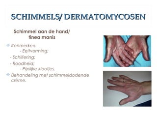 SCHIMMELS/ DERMATOMYCOSENSCHIMMELS/ DERMATOMYCOSEN
Schimmel aan de hand/
tinea manis
 Kenmerken:
- Eeltvorming;
- Schilfering;
- Roodheid;
- Pijnlijke kloofjes.
 Behandeling met schimmeldodende
crème.
 