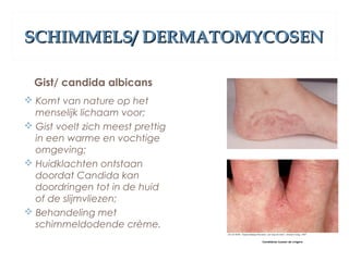 SCHIMMELS/ DERMATOMYCOSENSCHIMMELS/ DERMATOMYCOSEN
Gist/ candida albicans
 Komt van nature op het
menselijk lichaam voor;
 Gist voelt zich meest prettig
in een warme en vochtige
omgeving;
 Huidklachten ontstaan
doordat Candida kan
doordringen tot in de huid
of de slijmvliezen;
 Behandeling met
schimmeldodende crème.
 