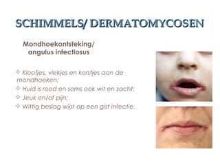 SCHIMMELS/ DERMATOMYCOSENSCHIMMELS/ DERMATOMYCOSEN
Mondhoekontsteking/
angulus infectiosus
 Kloofjes, vlekjes en korstjes aan de
mondhoeken;
 Huid is rood en soms ook wit en zacht;
 Jeuk en/of pijn;
 Wittig beslag wijst op een gist infectie.
 