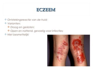 ECZEEMECZEEM
 Ontstekingsreactie van de huid;
 Varianten:
 Droog en gesloten;
 Open en nattend, gevoelig voor infecties;
 Niet besmettelijk!
 
