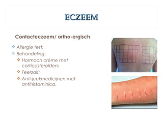 ECZEEMECZEEM
Contacteczeem/ ortho-ergisch
 Allergie test;
 Behandeling:
 Hormoon crème met
corticosteroïden;
 Teerzalf;
 Anti-jeukmedicijnen met
antihistaminica.
 