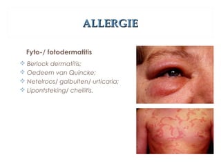 ALLERGIEALLERGIE
Fyto-/ fotodermatitis
 Berlock dermatitis;
 Oedeem van Quincke;
 Netelroos/ galbulten/ urticaria;
 Lipontsteking/ cheilitis.
 