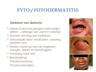 FYTO-/ FOTODERMATITIS
Oedeem van Quincke
 Dieper in de huid gelegen haarvaatjes
lekken → lekkage van vocht in weefsel;
 Grotere omvang dan netelroos;
 Veroorzaakt door: medicijnen, voeding,
dranken, etc;
 Treden vooral op aan de oogleden,
wangen, lippen en handruggen;
 Verwijzing naar arts;
 Behandeling:
Antihistaminica;
Corticosteroïden.
 