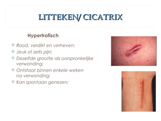 LITTEKEN/ CICATRIXLITTEKEN/ CICATRIX
Hypertrofisch
 Rood, verdikt en verheven;
 Jeuk of zelfs pijn;
 Dezelfde grootte als oorspronkelijke
verwonding;
 Ontstaat binnen enkele weken
na verwonding;
 Kan spontaan genezen;
 