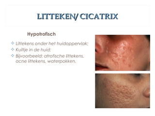LITTEKEN/ CICATRIXLITTEKEN/ CICATRIX
Hypotrofisch
 Littekens onder het huidoppervlak;
 Kuiltje in de huid;
 Bijvoorbeeld: atrofische littekens,
acne littekens, waterpokken.
 