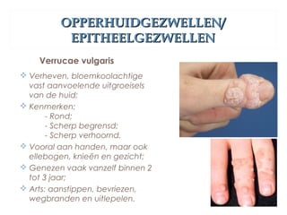 OPPERHUIDGEZWELLEN/OPPERHUIDGEZWELLEN/
EPITHEELGEZWELLENEPITHEELGEZWELLEN
Verrucae vulgaris
 Verheven, bloemkoolachtige
vast aanvoelende uitgroeisels
van de huid;
 Kenmerken:
- Rond;
- Scherp begrensd;
- Scherp verhoornd.
 Vooral aan handen, maar ook
ellebogen, knieën en gezicht;
 Genezen vaak vanzelf binnen 2
tot 3 jaar;
 Arts: aanstippen, bevriezen,
wegbranden en uitlepelen.
 