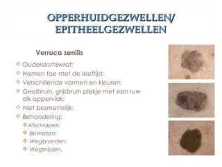 OPPERHUIDGEZWELLEN/OPPERHUIDGEZWELLEN/
EPITHEELGEZWELLENEPITHEELGEZWELLEN
Verruca senilis
 Ouderdomswrat;
 Nemen toe met de leeftijd;
 Verschillende vormen en kleuren;
 Geelbruin, grijsbruin plekje met een ruw
dik oppervlak;
 Niet besmettelijk;
 Behandeling:
Afschrapen;
 Bevriezen;
 Wegbranden;
 Wegsnijden.
 
