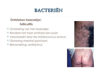 BACTERIËNBACTERIËN
Ontstoken haarzakje/
folliculitis
 Ontsteking van het haarzakje;
 Rondom het haar ontstaat een puist;
 Veroorzaakt door de stafylococcus aureus;
 Genezing meestal spontaan;
 Behandeling: antibiotica.
 