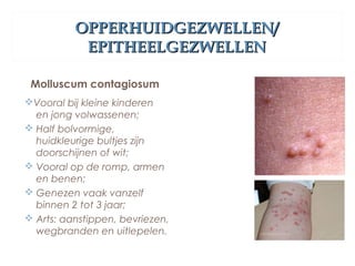 OPPERHUIDGEZWELLEN/OPPERHUIDGEZWELLEN/
EPITHEELGEZWELLENEPITHEELGEZWELLEN
Molluscum contagiosum
Vooral bij kleine kinderen
en jong volwassenen;
 Half bolvormige,
huidkleurige bultjes zijn
doorschijnen of wit;
 Vooral op de romp, armen
en benen;
 Genezen vaak vanzelf
binnen 2 tot 3 jaar;
 Arts: aanstippen, bevriezen,
wegbranden en uitlepelen.
 