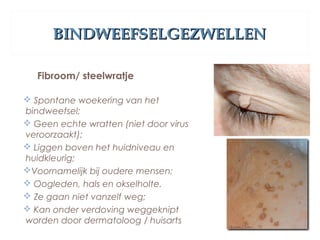 BINDWEEFSELGEZWELLENBINDWEEFSELGEZWELLEN
Fibroom/ steelwratje
 Spontane woekering van het
bindweefsel;
 Geen echte wratten (niet door virus
veroorzaakt);
 Liggen boven het huidniveau en
huidkleurig;
Voornamelijk bij oudere mensen;
 Oogleden, hals en okselholte.
 Ze gaan niet vanzelf weg;
 Kan onder verdoving weggeknipt
worden door dermatoloog / huisarts
 