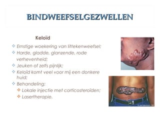 BINDWEEFSELGEZWELLENBINDWEEFSELGEZWELLEN
Keloïd
 Ernstige woekering van littekenweefsel;
 Harde, gladde, glanzende, rode
verhevenheid;
 Jeuken of zelfs pijnlijk;
 Keloïd komt veel voor mij een donkere
huid;
 Behandeling:
 Lokale injectie met corticosteroïden;
 Lasertherapie.
 