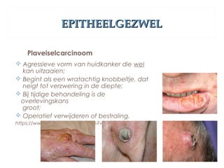 EPITHEELGEZWELEPITHEELGEZWEL
Plaveiselcarcinoom
 Agressieve vorm van huidkanker die wel
kan uitzaaien;
 Begint als een wratachtig knobbeltje, dat
neigt tot verzwering in de diepte;
 Bij tijdige behandeling is de
overlevingskans
groot;
 Operatief verwijderen of bestraling.
https://www.youtube.com/watch?v=6JRzOR16g10
 