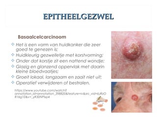 EPITHEELGEZWELEPITHEELGEZWEL
Basaalcelcarcinoom
 Het is een vorm van huidkanker die zeer
goed te genezen is;
 Huidkleurig gezwelletje met korstvorming;
 Onder dat korstje zit een nattend wondje;
 Glazig en glanzend oppervlak met daarin
kleine bloedvaatjes;
 Groeit lokaal, langzaam en zaait niet uit;
 Operatief verwijderen of bestralen.
https://www.youtube.com/watch?
annotation_id=annotation_398820&feature=iv&src_vid=6JRzO
R16g10&v=_yR30NPIxp4
 