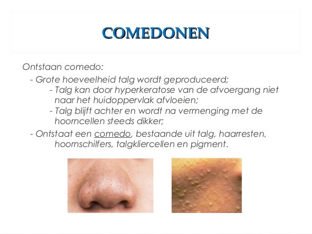witte comedonen