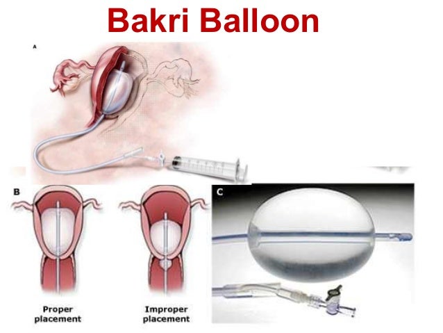 bakri balloon ideal vistalist co bakri balloon