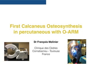 First Calcaneus Osteosynthesis
in percutaneous with O-ARM
Dr François Molinier
Clinique des Cèdres
Cornebarrieu - Toulouse
France
 