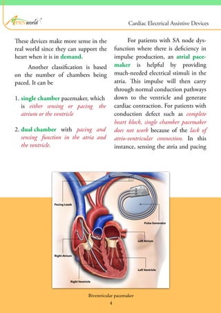 ®
These devices make more sense in the
real world since they can support the
heart when it is in demand.
Another classification is based
on the number of chambers being
paced. It can be
1. single chamber pacemaker, which
is either sensing or pacing the
atrium or the ventricle
2. dual chamber with pacing and
sensing function in the atria and
the ventricle.
For patients with SA node dys-
function where there is deficiency in
impulse production, an atrial pace-
maker is helpful by providing
much-needed electrical stimuli in the
atria. This impulse will then carry
through normal conduction pathways
down to the ventricle and generate
cardiac contraction. For patients with
conduction defect such as complete
heart block, single chamber pacemaker
does not work because of the lack of
atrio-ventricular connection. In this
instance, sensing the atria and pacing
Biventricular pacemaker
4
Cardiac Electrical Assistive Devices
 