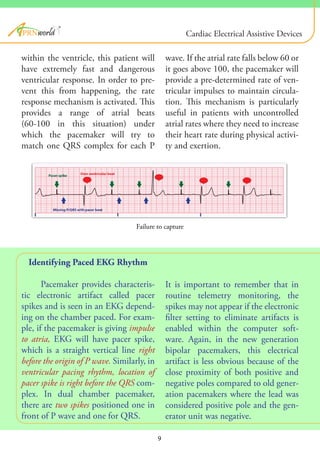 Failure to capture
Identifying Paced EKG Rhythm
Pacemaker provides characteris-
tic electronic artifact called pacer
spikes and is seen in an EKG depend-
ing on the chamber paced. For exam-
ple, if the pacemaker is giving impulse
to atria, EKG will have pacer spike,
which is a straight vertical line right
before the origin of P wave. Similarly, in
ventricular pacing rhythm, location of
pacer spike is right before the QRS com-
plex. In dual chamber pacemaker,
there are two spikes positioned one in
front of P wave and one for QRS.
within the ventricle, this patient will
have extremely fast and dangerous
ventricular response. In order to pre-
vent this from happening, the rate
response mechanism is activated. This
provides a range of atrial beats
(60-100 in this situation) under
which the pacemaker will try to
match one QRS complex for each P
It is important to remember that in
routine telemetry monitoring, the
spikes may not appear if the electronic
filter setting to eliminate artifacts is
enabled within the computer soft-
ware. Again, in the new generation
bipolar pacemakers, this electrical
artifact is less obvious because of the
close proximity of both positive and
negative poles compared to old gener-
ation pacemakers where the lead was
considered positive pole and the gen-
erator unit was negative.
wave. If the atrial rate falls below 60 or
it goes above 100, the pacemaker will
provide a pre-determined rate of ven-
tricular impulses to maintain circula-
tion. This mechanism is particularly
useful in patients with uncontrolled
atrial rates where they need to increase
their heart rate during physical activi-
ty and exertion.
9
®
Cardiac Electrical Assistive Devices
 