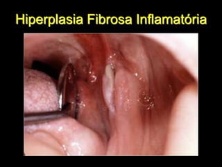 Hiperplasia Fibrosa Inflamatória
 