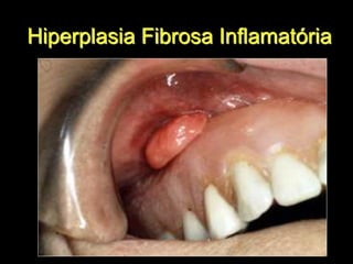Hiperplasia Fibrosa Inflamatória
 