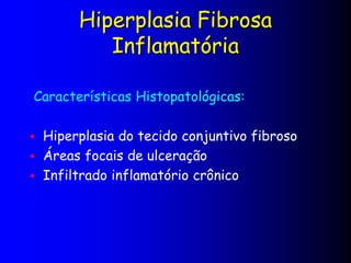 Hiperplasia Fibrosa
Inflamatória
Características Histopatológicas:
 Hiperplasia do tecido conjuntivo fibroso
 Áreas focais de ulceração
 Infiltrado inflamatório crônico
 